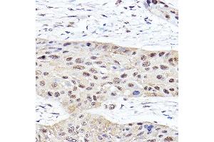 Immunohistochemistry of paraffin-embedded human esophageal cancer using PSMB2 Rabbit pAb (ABIN6129442, ABIN6146314, ABIN6146316 and ABIN6221150) at dilution of 1:100 (40x lens). (PSMB2 antibody  (AA 1-201))