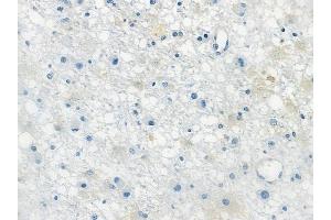 ABIN6259509 and ABIN6273958 at 1/100 staining human astrocytoma by IHC-P.