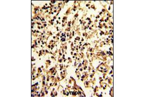 Formalin-fixed and paraffin-embedded human lymph with SERPINA9 Antibody , which was peroxidase-conjugated to the secondary antibody, followed by DAB staining. (SERPINA9 antibody  (AA 194-222))