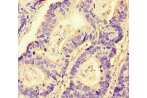 Immunohistochemistry of paraffin-embedded human colon cancer using ABIN7161435 at dilution of 1:100 (NRP2 antibody  (AA 60-209))