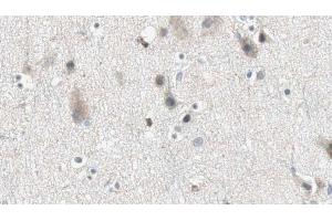 ABIN6274868 at 1/100 staining Human brain cancer tissue by IHC-P.