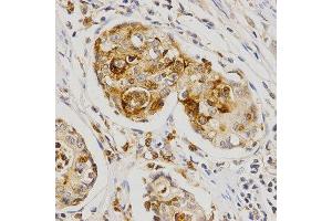Immunohistochemistry of paraffin-embedded human stomach cancer using OLR1 antibody at dilution of 1:200 (x400 lens). (OLR1 antibody  (AA 58-273))