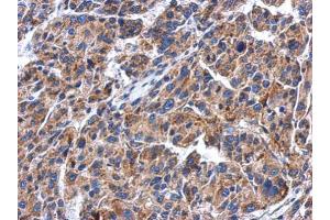 IHC-P Image Immunohistochemical analysis of paraffin-embedded human hepatoma, using GBA, antibody at 1:500 dilution. (GBA antibody  (Center))
