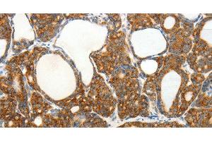 Immunohistochemistry of paraffin-embedded Human thyroid cancer tissue using SLC12A4 Polyclonal Antibody at dilution 1:30 (SLC12A4 antibody)