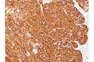 Formalin-fixed, paraffin-embedded human Melanoma stained with Melanoma Marker Monoclonal Antibody (M2-7C10 + M2-9E3 + T311 + HMB45). (Melanoma Marker (MART-1 + Tyrosinase + Gp100) antibody)