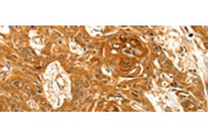 Immunohistochemistry of paraffin-embedded Human esophagus cancer tissue using VSNL1 Polyclonal Antibody at dilution of 1:25(x200) (VSNL1 antibody)