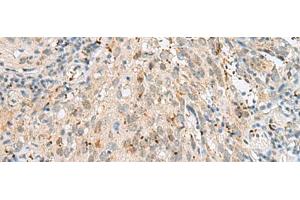 Immunohistochemistry of paraffin-embedded Human cervical cancer tissue using GTF3C2 Polyclonal Antibody at dilution of 1:45(x200) (GTF3C2 antibody)
