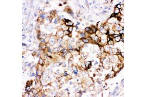 Anti- HMOX2 antibody, IHC(P) IHC(P): Human Lung Cancer Tissue (HMOX2 antibody  (AA 2-316))