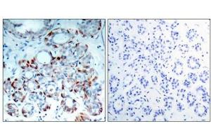 Immunohistochemical analysis of paraffin-embedded human breast carcinoma tissue using BIM(Phospho-Ser69) Antibody(left) or the same antibody preincubated with blocking peptide(right). (BIM antibody  (pSer69))