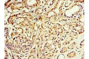 Immunohistochemistry of paraffin-embedded human breast cancer using ABIN7143649 at dilution of 1:100 (ADH1C antibody  (AA 1-375))