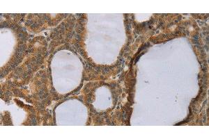 Immunohistochemistry of paraffin-embedded Human thyroid cancer using RNF5 Polyclonal Antibody at dilution of 1:35 (RNF5 antibody)