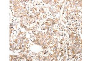Immunohistochemical analysis of paraffin-embedded Human breast cancer tissue using at dilution 1/30. (CDH23 antibody  (C-Term))