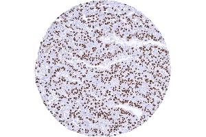 Strong nuclear TFE3 positivity in a renal cell carcinoma with TFE3 fusion (Recombinant TFE3 antibody)