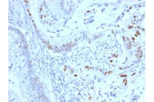 Formalin-fixed, paraffin-embedded human Colon Carcinoma stained with Cyclin E Mouse Monoclonal Antibody (CCNE1/2460).