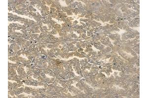 ABIN6260085 and ABIN6269286 at 1/100 staining human renal cell carcinoma by IHC-P.