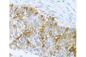 Immunohistochemistry of paraffin-embedded Human lung cancer using IFIT3 Polyclonal Antibody at dilution of 1:100 (40x lens).