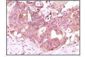 Immunohistochemical analysis of paraffin-embedded human recturn adenocarcinoma tissue showing cytoplasmic localization using FGF2 mouse mAb with DAB staining. (FGF2 antibody)