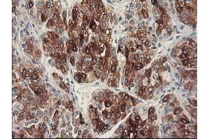Immunohistochemical staining of paraffin-embedded Carcinoma of Human liver tissue using anti-CYP2C9 mouse monoclonal antibody. (CYP2C9 antibody)