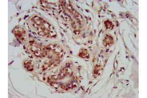 IHC image of ABIN7172782 diluted at 1:800 and staining in paraffin-embedded human breast cancer performed on a Leica BondTM system. (GATAD2A antibody  (AA 170-241))