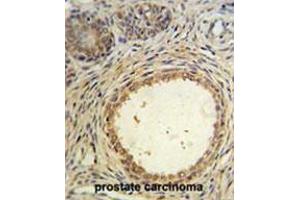 AMH Antibody (Center) IHC analysis in formalin fixed and paraffin embedded prostate carcinoma followed by peroxidase conjugation of the secondary antibody and DAB staining. (AMH antibody  (Middle Region))