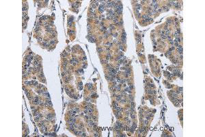 Immunohistochemistry of Human breast cancer using IPO7 Polyclonal Antibody at dilution of 1:40 (IPO7 antibody)