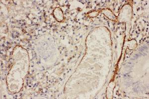 Anti-ICAM1 Picoband antibody,  IHC(P): Human Intestinal Cancer Tissue