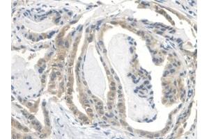 Detection of IGFBP2 in Human Thyroid cancer Tissue using Polyclonal Antibody to Insulin Like Growth Factor Binding Protein 2 (IGFBP2) (IGFBP2 antibody  (AA 148-325))