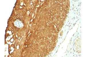 Formalin-fixed, paraffin-embedded human Cervical Carcinoma stained with Cytokeratin 19 Mouse Monoclonal Antibody (KRT19/800). (Cytokeratin 19 antibody)