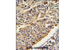CTSE Antibody IHC analysis in formalin fixed and paraffin embedded human lung carcinoma followed by peroxidase conjugation of the secondary antibody and DAB staining. (Cathepsin E antibody  (AA 157-187))