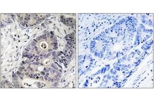 Immunohistochemistry analysis of paraffin-embedded human colon carcinoma, using iNOS (Phospho-Tyr151) Antibody. (NOS2 antibody  (pTyr151))