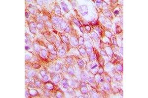 Immunohistochemical analysis of EP2 staining in human prostate cancer formalin fixed paraffin embedded tissue section. (PTGER2 antibody  (C-Term))