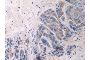Detection of FBLN1 in Human Breast cancer Tissue using Polyclonal Antibody to Fibulin 1 (FBLN1)