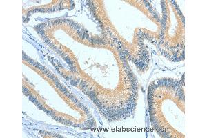 Immunohistochemistry of Human colon cancer using ASGR1 Polyclonal Antibody at dilution of 1:50 (Asialoglycoprotein Receptor 1 antibody)