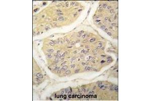 Formalin-fixed and paraffin-embedded human lung carcinoma tissue reacted with B2M antibody (N-term) (ABIN389258 and ABIN2839396) , which was peroxidase-conjugated to the secondary antibody, followed by DAB staining. (beta-2 Microglobulin antibody  (N-Term))