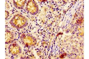 IHC image of ABIN7151882 diluted at 1:400 and staining in paraffin-embedded human colon cancer performed on a Leica BondTM system.
