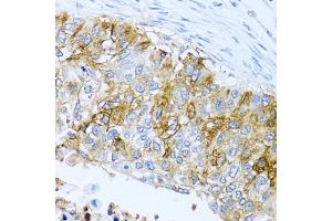 Immunohistochemistry of paraffin-embedded human lung cancer using IFIT3 antibody (ABIN1680389, ABIN3018293, ABIN3018295 and ABIN6220427) at dilution of 1:100 (40x lens). (IFIT3 antibody  (AA 128-331))