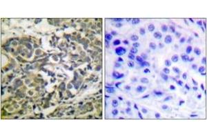 Immunohistochemistry analysis of paraffin-embedded human breast carcinoma, using AMPK alpha (Phospho-Thr172) Antibody. (AMPK alpha antibody  (pThr183))