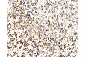 Immunohistochemistry analysis of paraffin-embedded human liver cancer using TEK Polyclonal Antibody at dilution of 1:200. (TEK antibody)