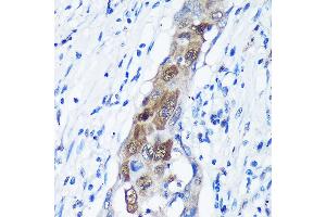 Immunohistochemistry of paraffin-embedded Human lung cancer using C Rabbit pAb (ABIN7266022) at dilution of 1:100 (40x lens). (CAMKK1 antibody  (AA 399-520))