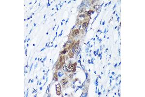 Immunohistochemistry of paraffin-embedded Human lung cancer using C Rabbit pAb (ABIN7266022) at dilution of 1:100 (40x lens).