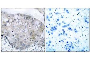 Immunohistochemical analysis of paraffin- embedded human breast carcinoma tissue using V (VEGFR2/CD309 antibody  (pTyr951))
