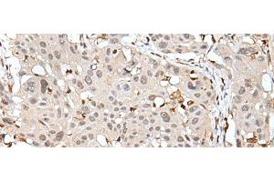 Immunohistochemistry of paraffin-embedded Human esophagus cancer tissue using ARHGDIB Polyclonal Antibody at dilution of 1:35(x200) (ARHGDIB antibody)