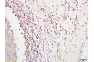 Formalin-fixed and paraffin embedded human breast carcinoma labeled with Rabbit Anti-Follistatin Polyclonal Antibody (ABIN734258) at 1:200 followed by conjugation to the secondary antibody and DAB staining. (Follistatin antibody  (AA 151-250))