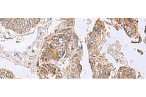 Immunohistochemistry of paraffin-embedded Human colorectal cancer tissue using RTKN2 Polyclonal Antibody at dilution of 1:75(x200) (RTKN2 antibody)