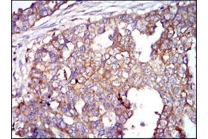 Immunohistochemical analysis of paraffin-embedded breast cancer tissues using G6PD mouse mAb with DAB staining. (Glucose-6-Phosphate Dehydrogenase antibody)