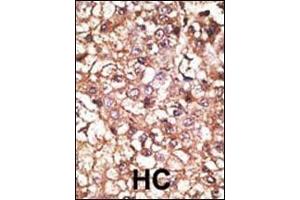 Formalin-fixed and paraffin-embedded human cancer tissue reacted with the primary antibody, which was peroxidase-conjugated to the secondary antibody, followed by AEC staining. (STUB1 antibody  (C-Term))