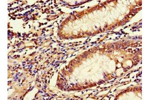 Immunohistochemistry of paraffin-embedded human colon cancer using ABIN7158054 at dilution of 1:100 (LRRIQ3 antibody  (AA 538-607))