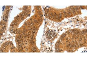 Immunohistochemistry of paraffin-embedded Human colon cancer tissue using SPDEF Polyclonal Antibody at dilution 1:60 (SPDEF/PSE antibody)