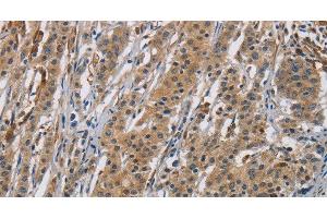 Immunohistochemistry of paraffin-embedded Human gastic cancer using RAGE Polyclonal Antibody at dilution of 1:70 (RAGE antibody)
