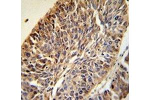 PITX1 antibody IHC analysis in formalin fixed and paraffin embedded human lung carcinoma. (PITX1 antibody  (AA 123-150))